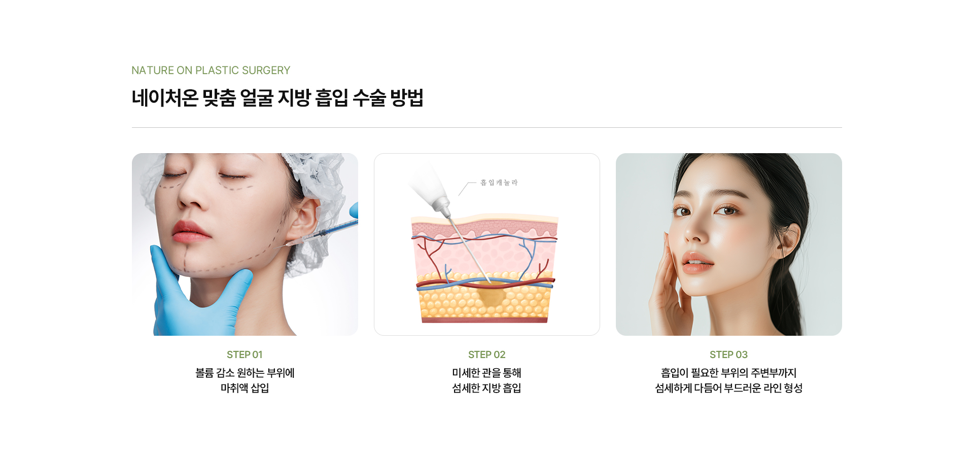 맞춤얼굴지방성형 상세08