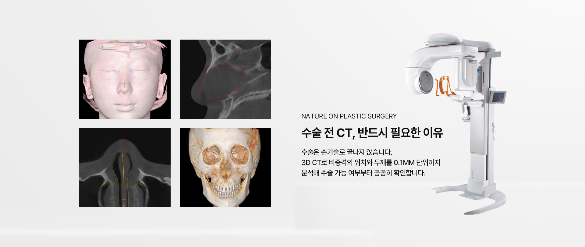 최소연골소프트라인코성형 상세08