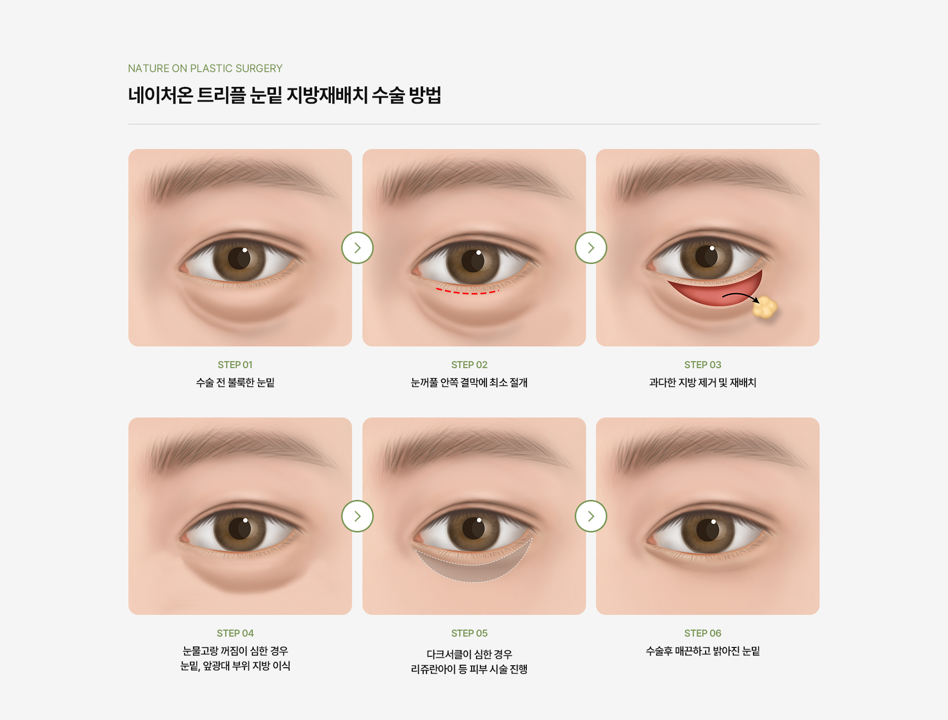 밸런스 트임 상세05