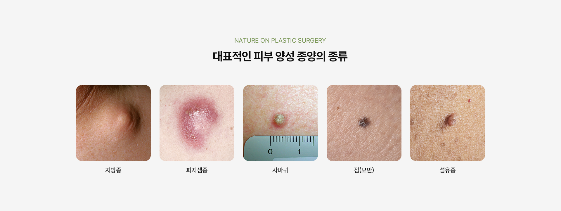 상처봉합피부종양 상세08